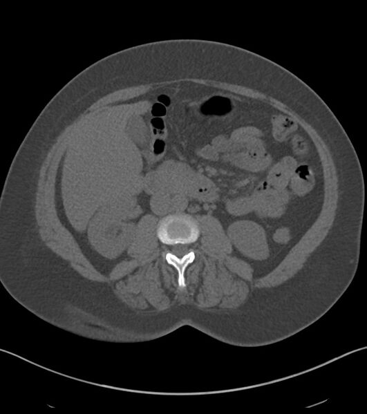 File:Calcified hepatic hydatid cyst (Radiopaedia 81127-94738 Axial non-contrast 46).jpg