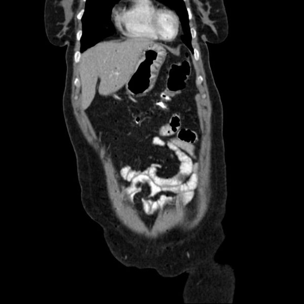 File:Calcified hydatid cyst of the liver (Radiopaedia 21212-21112 D 4).jpg