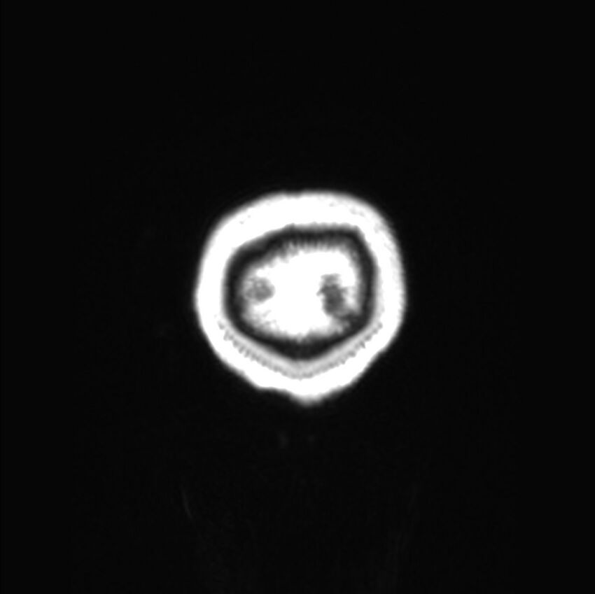 Callosal dysgenesis with interhemispheric cyst (Radiopaedia 53355-59335 Coronal T1 1).jpg