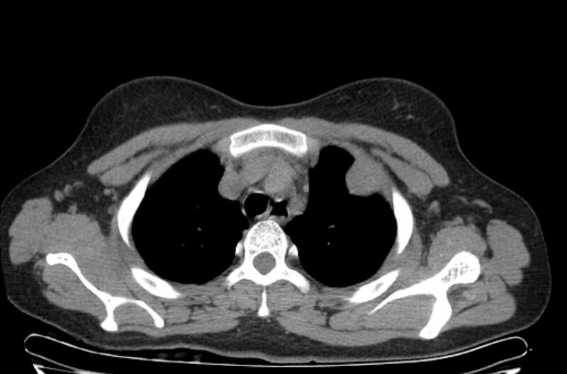 File:Cannonball metastases - uterine choriocarcinoma (Radiopaedia 70137-80173 Axial non-contrast 16).jpg
