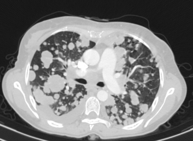 File:Cannonball metastases from breast cancer (Radiopaedia 91024-108569 Axial lung window 38).jpg