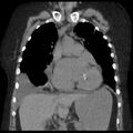 Cardiogenic pulmonary edema (Radiopaedia 29213-29609 Coronal non-contrast 16).jpg