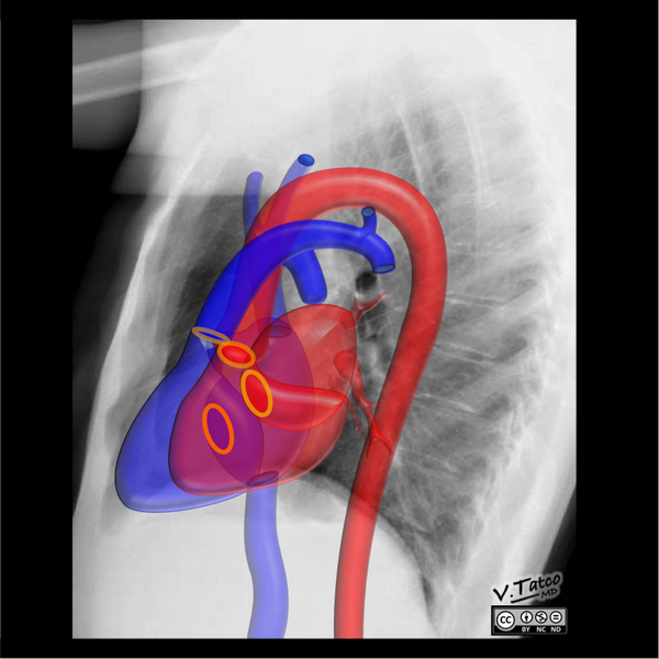 File:Cardiomediastinal anatomy on chest radiography (annotated images) (Radiopaedia 46331-50772 O 1).png