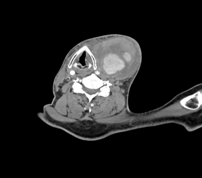 File:Carotid artery pseudoaneurysm (Radiopaedia 84030-99259 C 52).jpg
