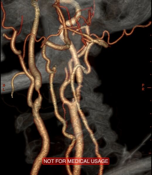 File:Carotid artery stenosis (Radiopaedia 28786-29086 A 6).jpg