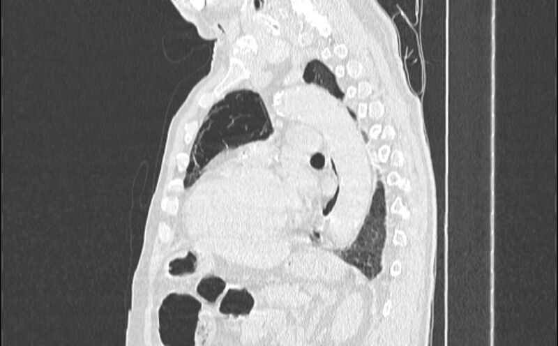 File:Cavitating bronchogenic carcinoma (Radiopaedia 44489-48162 Sagittal lung window 39).jpg