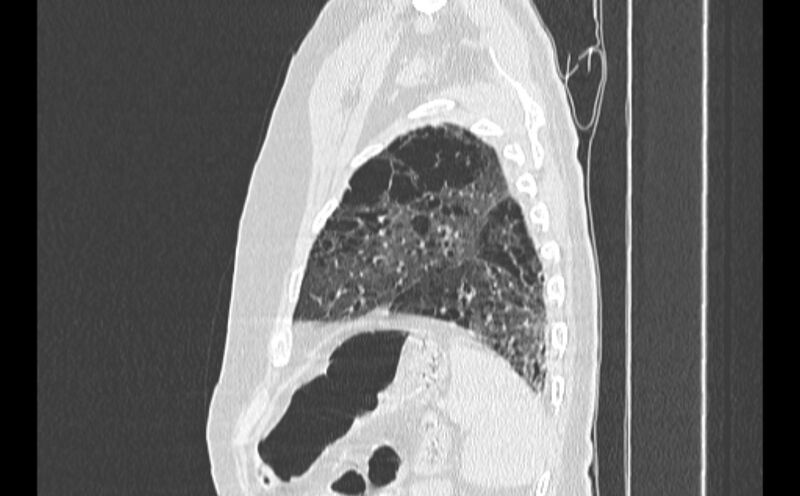 File:Cavitating bronchogenic carcinoma (Radiopaedia 44489-48162 Sagittal lung window 59).jpg