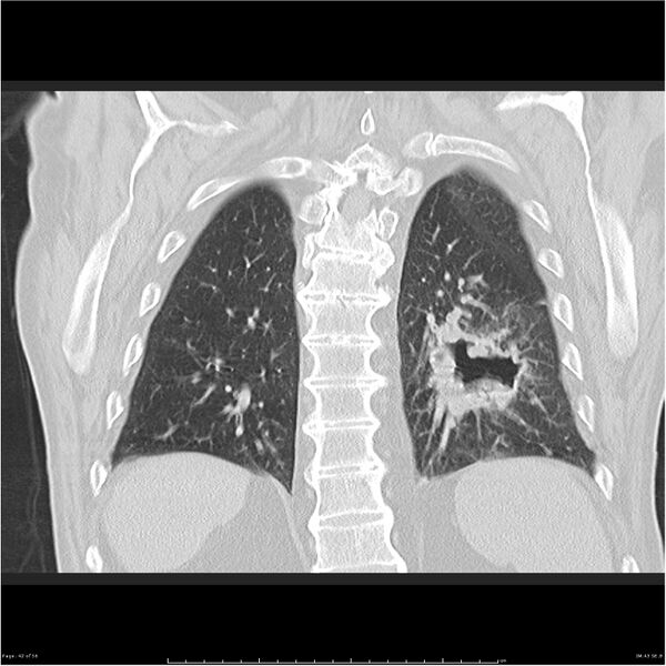 File:Cavitating left lower lobe lesion - squamous cell lung cancer (Radiopaedia 27749-28176 Coronal lung window 42).jpg