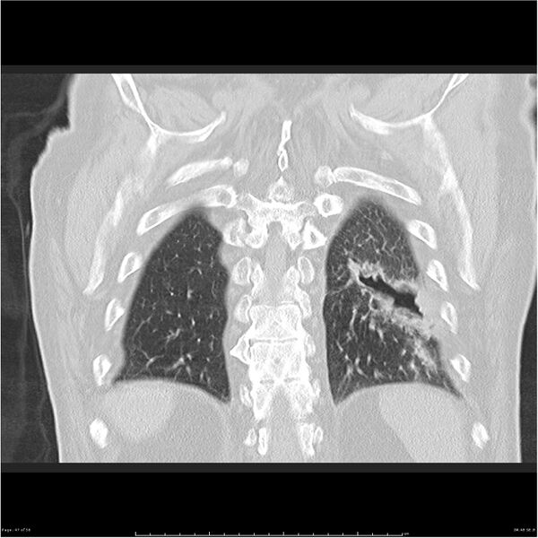 File:Cavitating left lower lobe lesion - squamous cell lung cancer (Radiopaedia 27749-28176 Coronal lung window 47).jpg