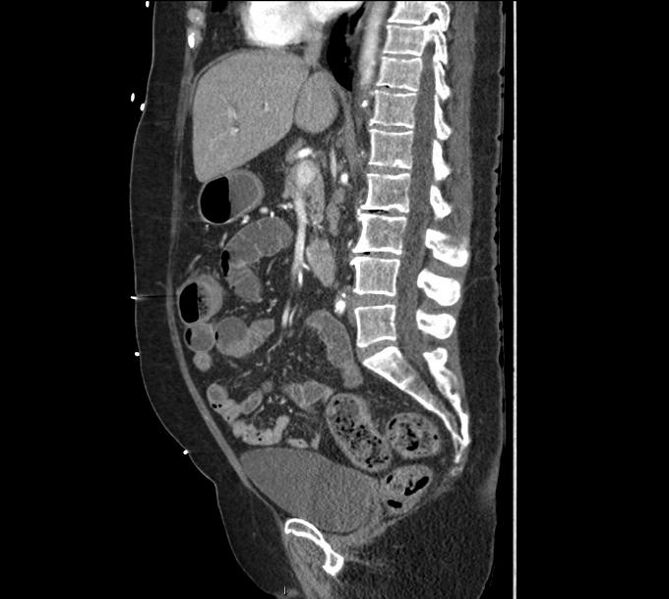 File:Celiac artery severe stenosis and dissection (Radiopaedia 44128-47842 A 23).jpg