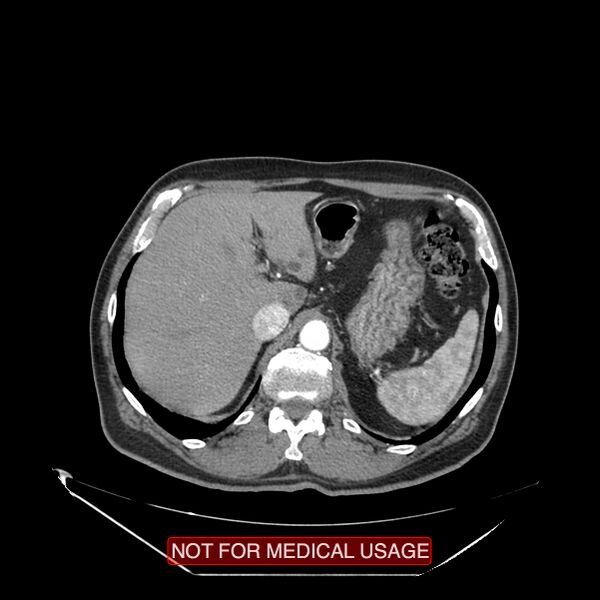 File:Celiac trunk variant anatomy - gastrohepatic trunk and splenic artery (Radiopaedia 38815-40995 A 5).jpg