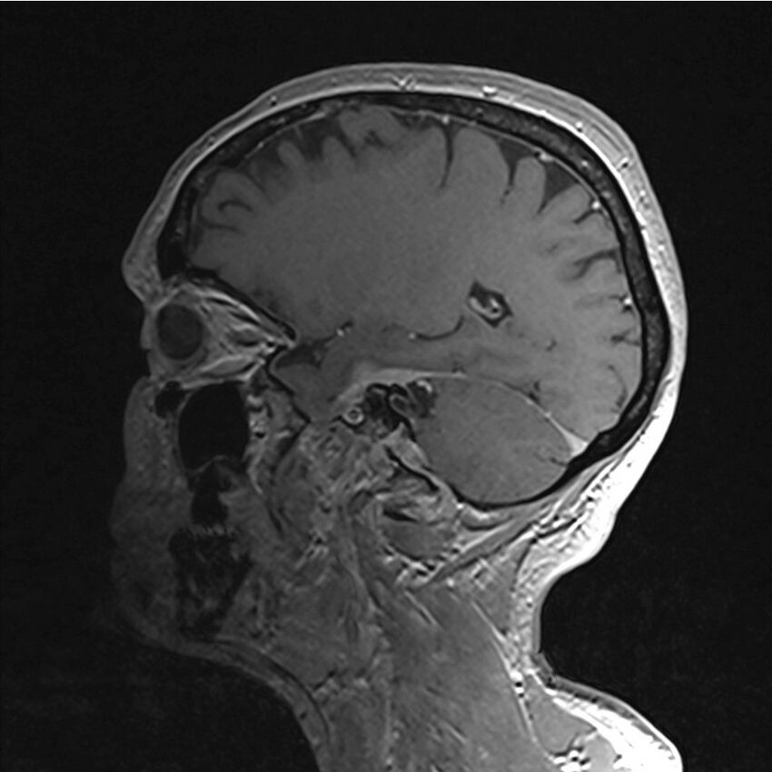 Central base of skull meningioma (Radiopaedia 53531-59549 Sagittal T1 C+ 51).jpg
