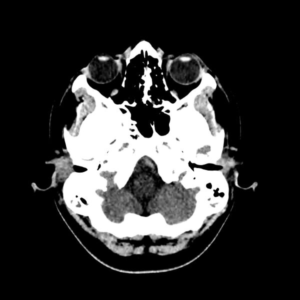 File:Central nervous system Langerhans cell histiocytosis (Radiopaedia 65728-74878 Axial non-contrast 11).jpg