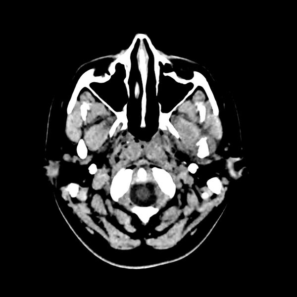 File:Central nervous system Langerhans cell histiocytosis (Radiopaedia 65728-74878 Axial non-contrast 6).jpg