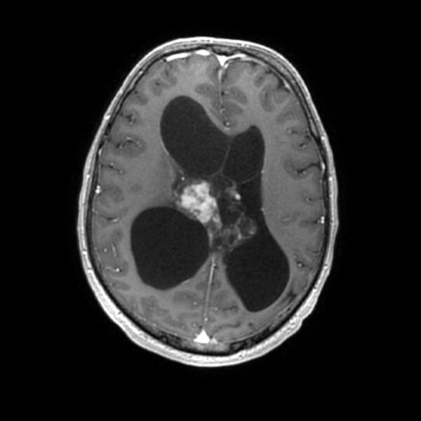 File:Central neurocytoma (Radiopaedia 67618-77021 Axial T1 C+ 18).jpg