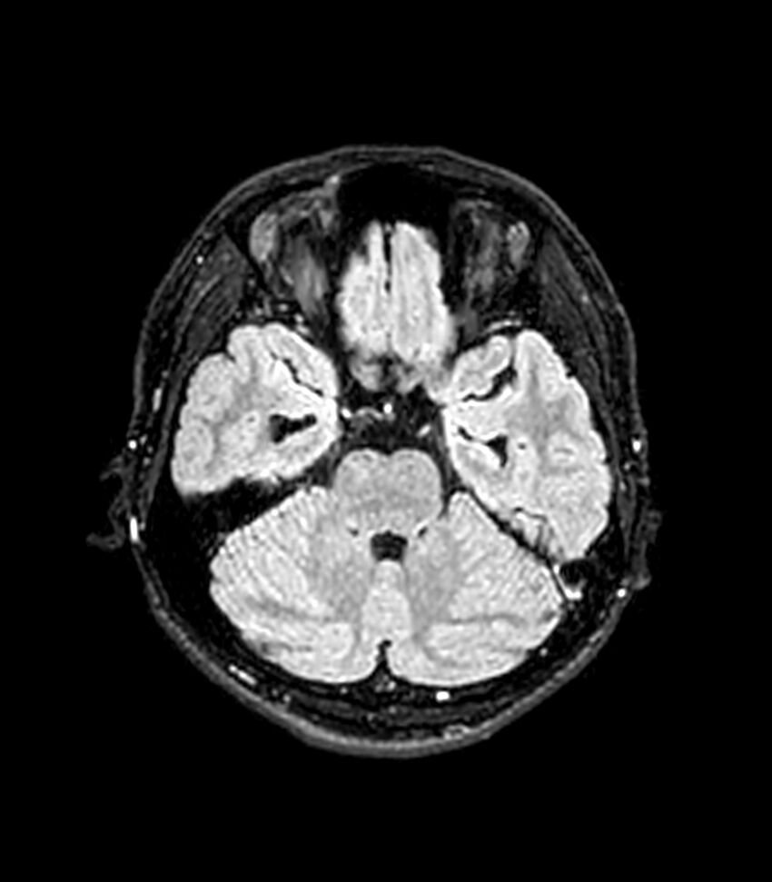Central neurocytoma (Radiopaedia 79320-92380 Axial FLAIR 211).jpg
