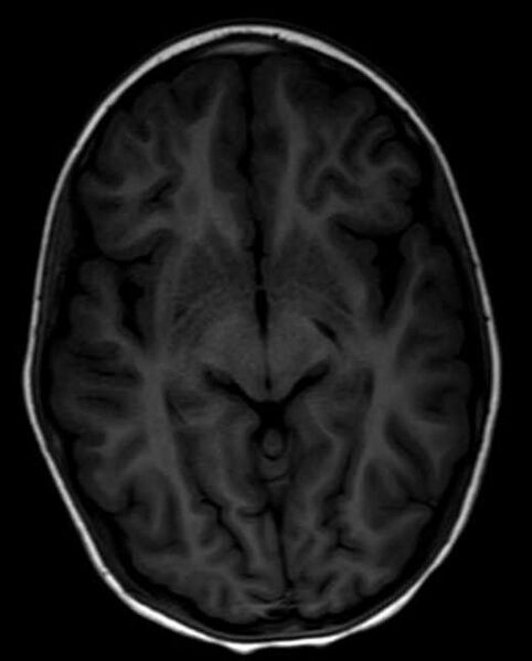 File:Cerebellar abscess (Radiopaedia 73727-84563 Axial T1 16).jpg
