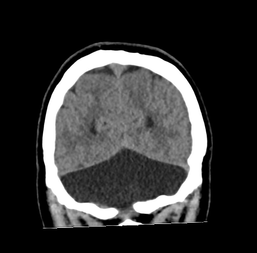 Cerebellar agenesis (Radiopaedia 30203-30817 Coronal non-contrast 41).jpg