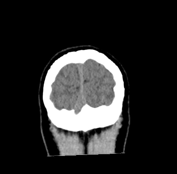 File:Cerebellar agenesis (Radiopaedia 30203-30817 Coronal non-contrast 48).jpg