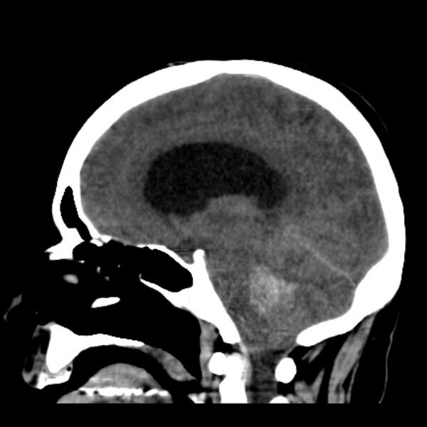 File:Cerebellar hemorrhage causing obstructive hydrocephalus (Radiopaedia 33989-35207 B 27).jpg