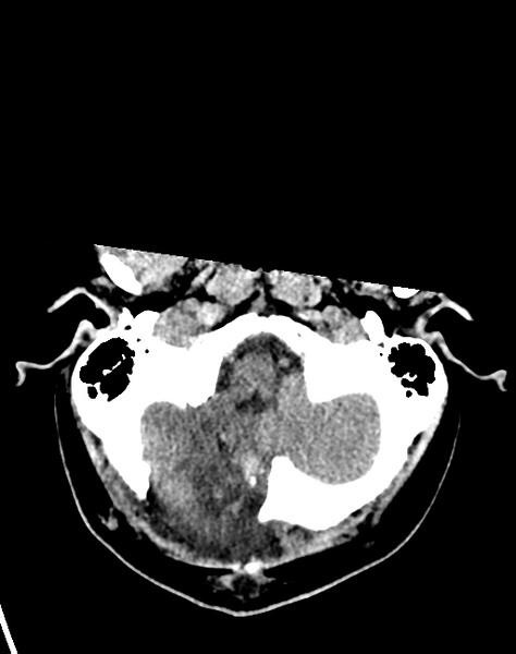 File:Cerebellar infarct due to vertebral artery dissection with posterior fossa decompression (Radiopaedia 82779-97033 Axial non-contrast 7).png