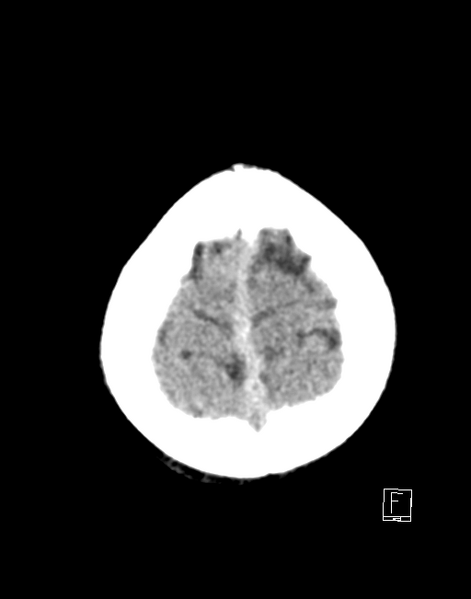 File:Cerebellar stroke (Radiopaedia 32202-33149 Axial non-contrast 27).png
