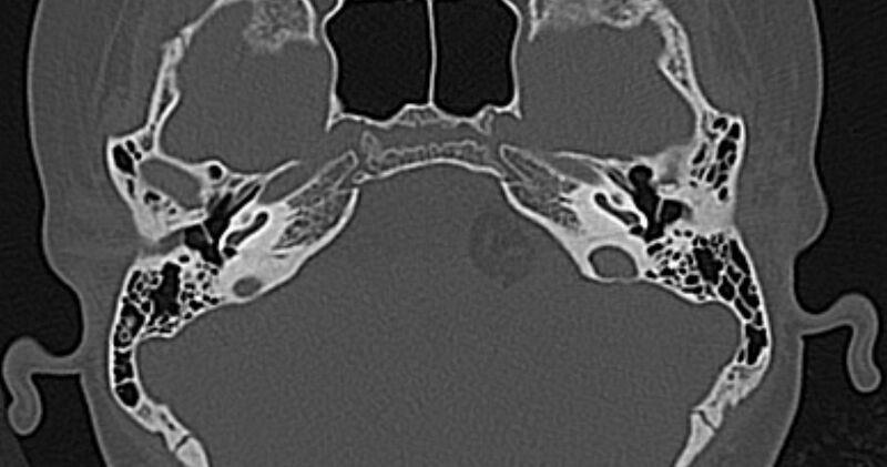 File:Cerebellopontine angle lipoma (Radiopaedia 57303-64242 Axial bone window 23).jpg