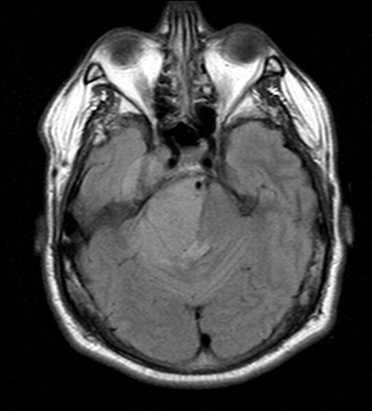 File:Cerebellopontine angle meningioma (Radiopaedia 24459-24764 Axial FLAIR 8).jpg
