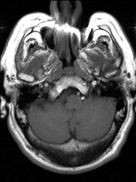 File:Cerebellopontine angle meningioma (Radiopaedia 24459-24764 Axial T1 3).jpg