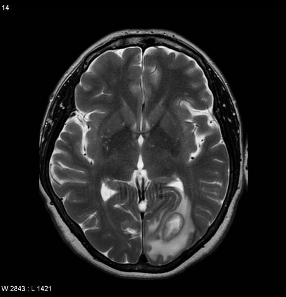 File:Cerebral abscess - shaggy borders (Radiopaedia 5492-7225 Axial T2 1).jpg