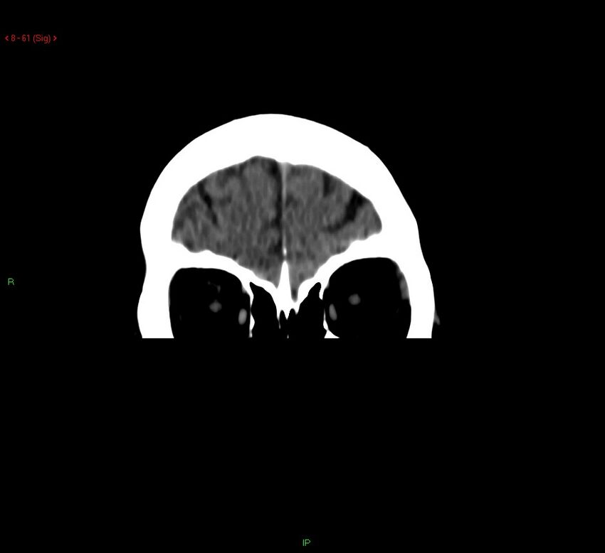 Cerebral amyloid angiopathy-associated lobar intracerebral hemorrhage (Radiopaedia 58378-65518 Coronal non-contrast 61).jpg