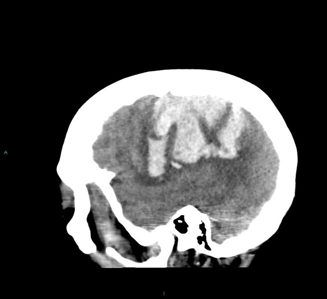 File:Cerebral amyloid angiopathy-associated lobar intracerebral hemorrhage (Radiopaedia 58379-65519 C 12).jpg