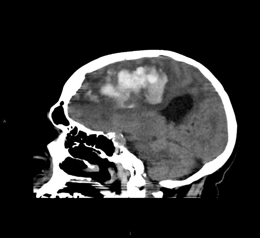 Cerebral amyloid angiopathy-associated lobar intracerebral hemorrhage (Radiopaedia 58560-65723 C 22).jpg
