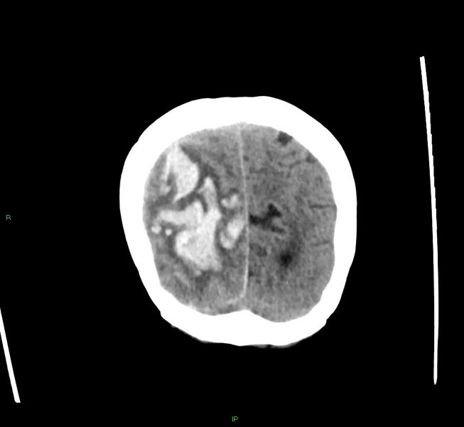 File:Cerebral amyloid angiopathy-associated lobar intracerebral hemorrhage (Radiopaedia 58563-65727 Coronal non-contrast 13).jpg