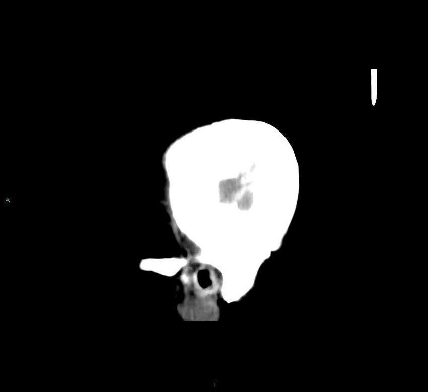 Cerebral amyloid angiopathy-associated lobar intracerebral hemorrhage (Radiopaedia 58751-65972 C 49).jpg