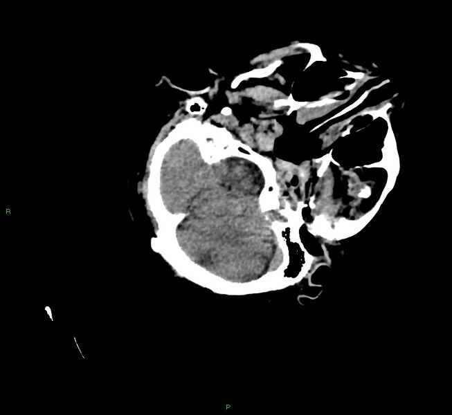 File:Cerebral amyloid angiopathy-associated lobar intracerebral hemorrhage (Radiopaedia 58757-65979 Axial non-contrast 29).jpg