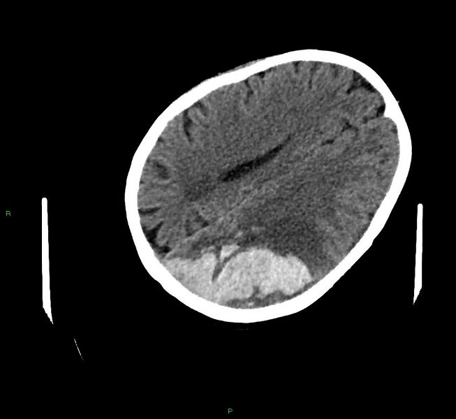 File:Cerebral amyloid angiopathy-associated lobar intracerebral hemorrhage (Radiopaedia 58757-65979 Axial non-contrast 86).jpg