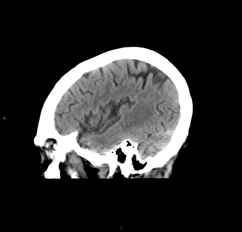 Cerebral amyloid angiopathy-associated lobar intracerebral hemorrhage (Radiopaedia 59356-66716 C 42).jpg