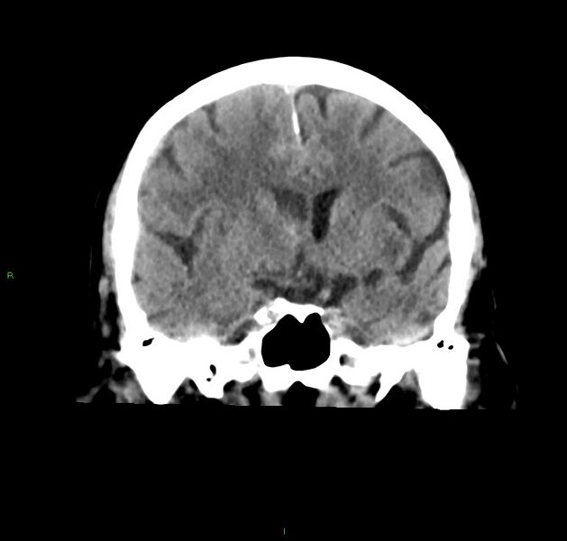 File:Cerebral amyloid angiopathy-associated lobar intracerebral hemorrhage (Radiopaedia 59356-66716 Coronal non-contrast 39).jpg