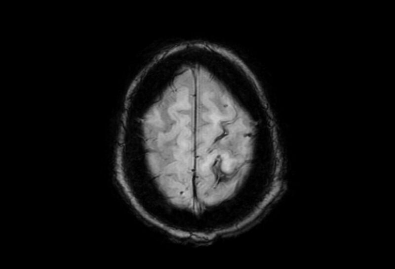 File:Cerebral amyloid angiopathy (Radiopaedia 86671-102792 Axial Gradient Echo 6).jpg