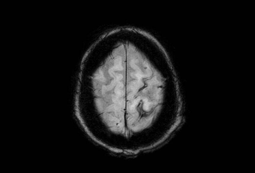 Cerebral amyloid angiopathy (Radiopaedia 86671-102792 Axial Gradient Echo 6).jpg
