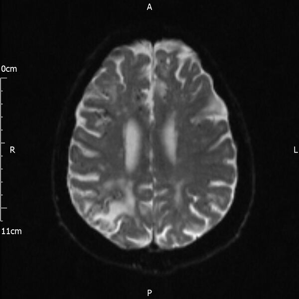 File:Cerebral amyloid angiopathy related inflammation (Radiopaedia 72772-83415 Axial DWI 16).jpg