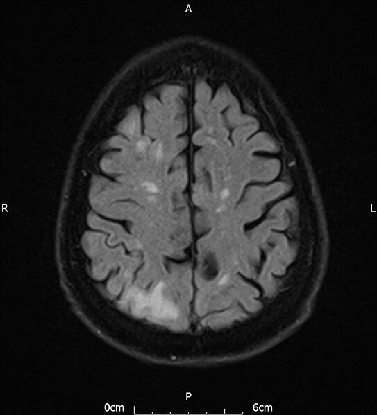 File:Cerebral amyloid angiopathy related inflammation (Radiopaedia 72772-83415 Axial FLAIR 18).jpg