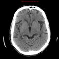 Cerebral and orbital tuberculomas (Radiopaedia 13308-13310 Axial non-contrast 13).jpg