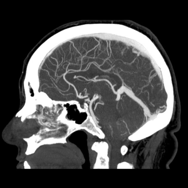 File:Cerebral arteriovenous malformation (Radiopaedia 43729-47189 D 25).jpg