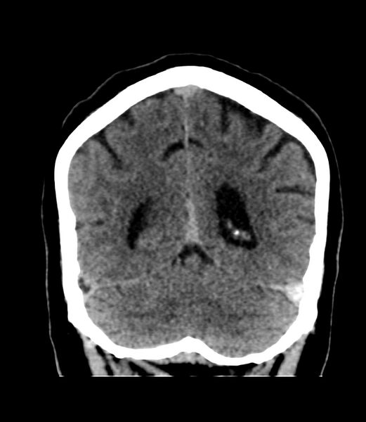 File:Cerebral dural venous sinus thrombosis (Radiopaedia 86514-102575 Coronal non-contrast 39).jpg