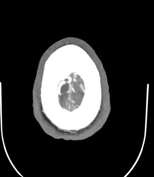 File:Cerebral dural venous sinus thrombosis (Radiopaedia 86514-102576 A 88).jpg