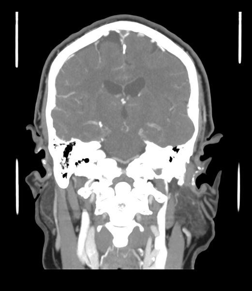 File:Cerebral dural venous sinus thrombosis (Radiopaedia 86514-102576 B 38).jpg
