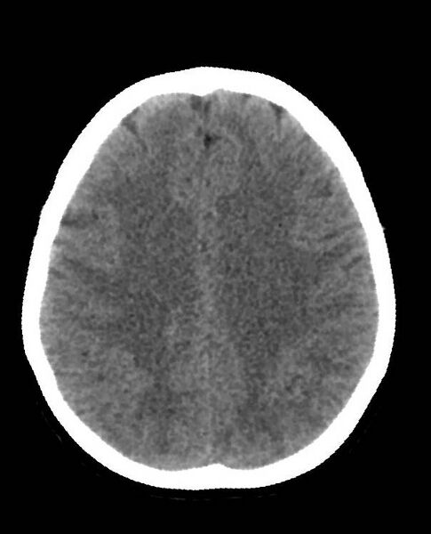 File:Cerebral edema due to severe hyponatremia (Radiopaedia 89826-106938 Axial non-contrast 70).jpg