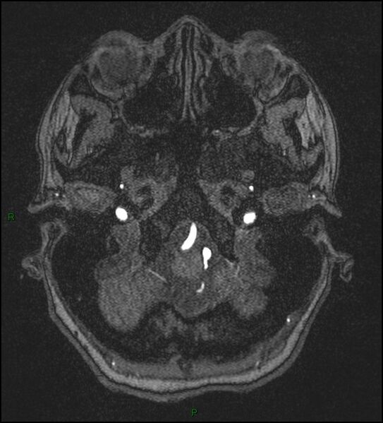 File:Cerebral fat embolism (Radiopaedia 35022-36525 Axial TOF 21).jpg